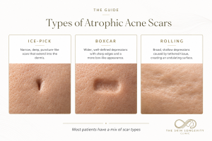 Types of atrophic acne scars including ice pick scars, boxcar scars and rolling scars
