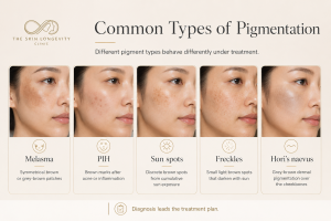 Common types of pigmentation including melasma, PIH, sun spots, freckles and Hori’s naevus in Asian skin