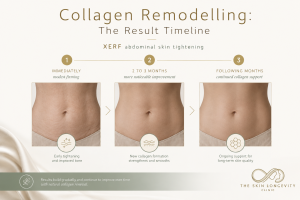 XERF abdominal skin tightening results timeline showing early firmness, collagen remodelling and gradual improvement