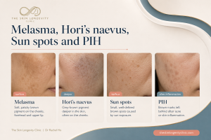 Hyperrealistic Asian cheek examples showing the visual patterns of melasma, Hori’s naevus, sun spots and PIH