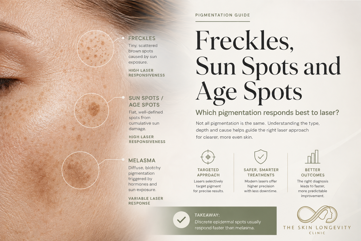 Freckles, sun spots and age spots compared with melasma by pigment pattern and typical laser responsiveness in Singapore.