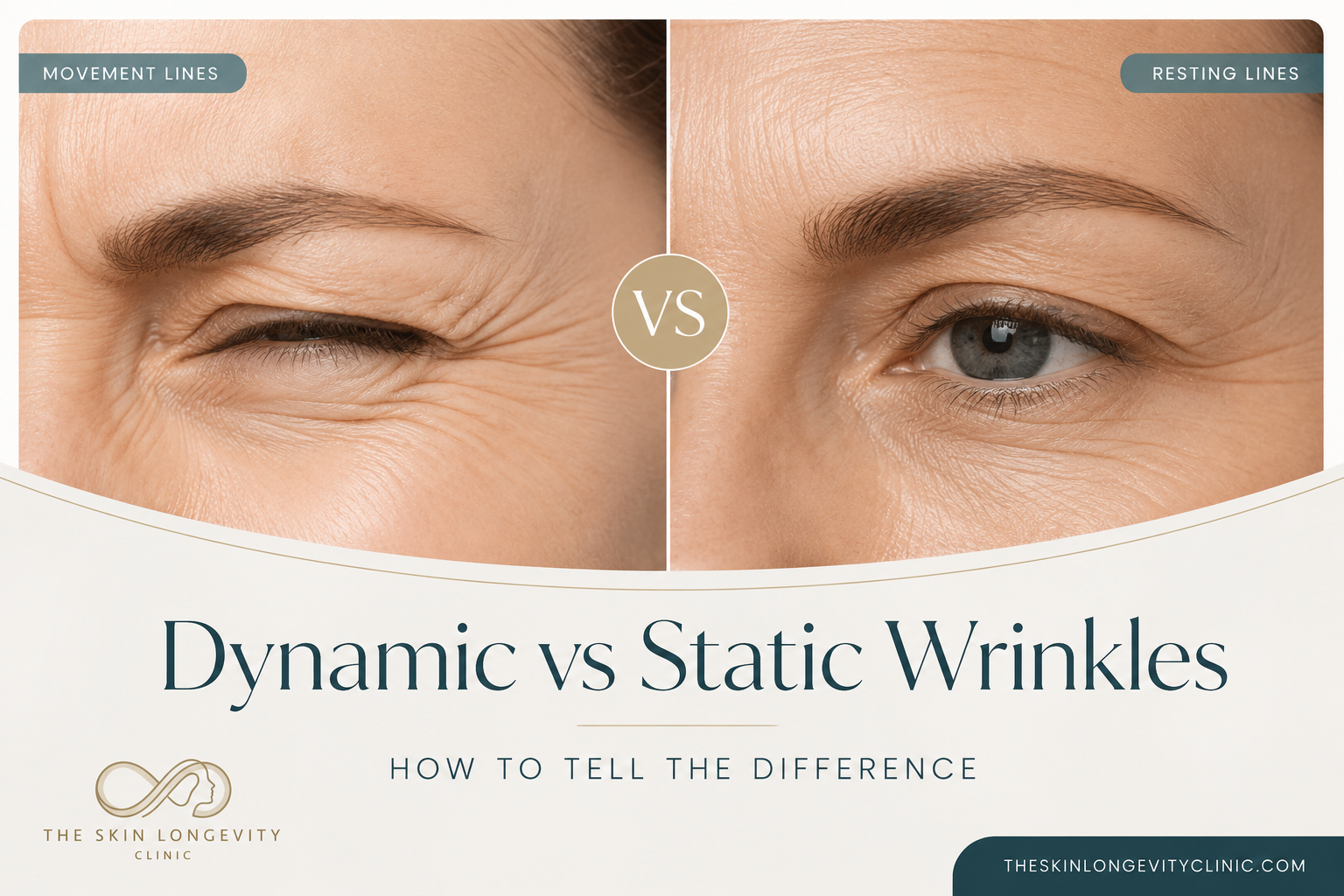 Close up comparison of eye area wrinkles showing movement lines during expression versus resting lines at rest, illustrating dynamic versus static wrinkles.