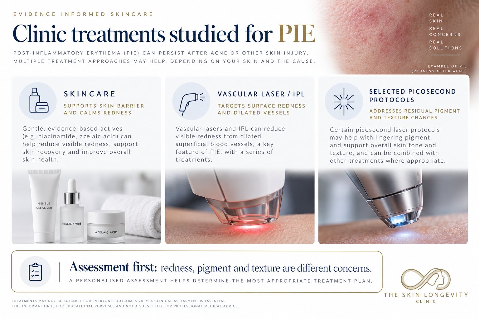 Clinic treatments studied for PIE red acne marks: skincare with niacinamide and azelaic acid, vascular laser or IPL for dilated vessels, and selected picosecond laser protocols; assessment first