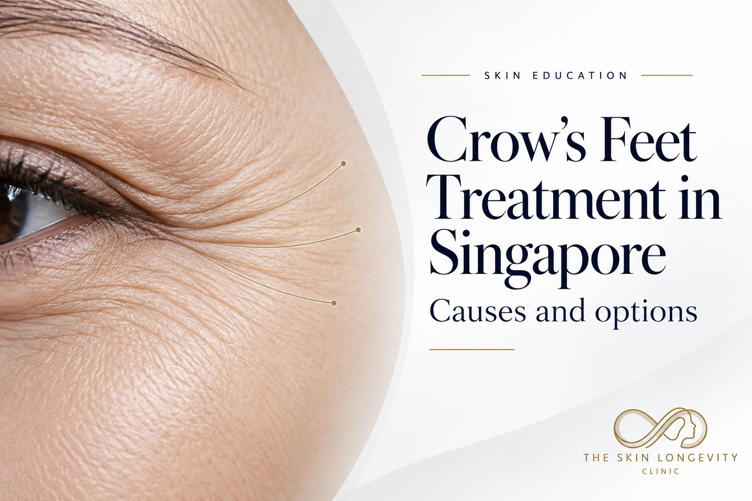 Crow’s feet treatment in Singapore: causes and options, close-up of lines at the outer corner of the eye