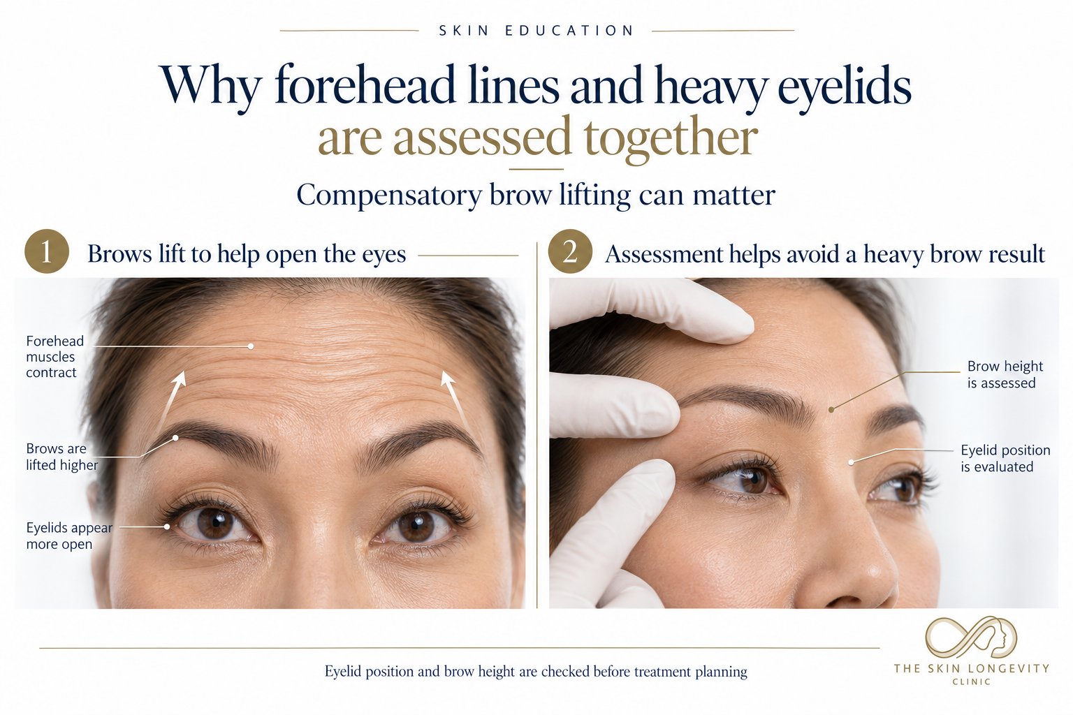 Why forehead lines and heavy eyelids are assessed together: compensatory brow lifting, brow height and eyelid position