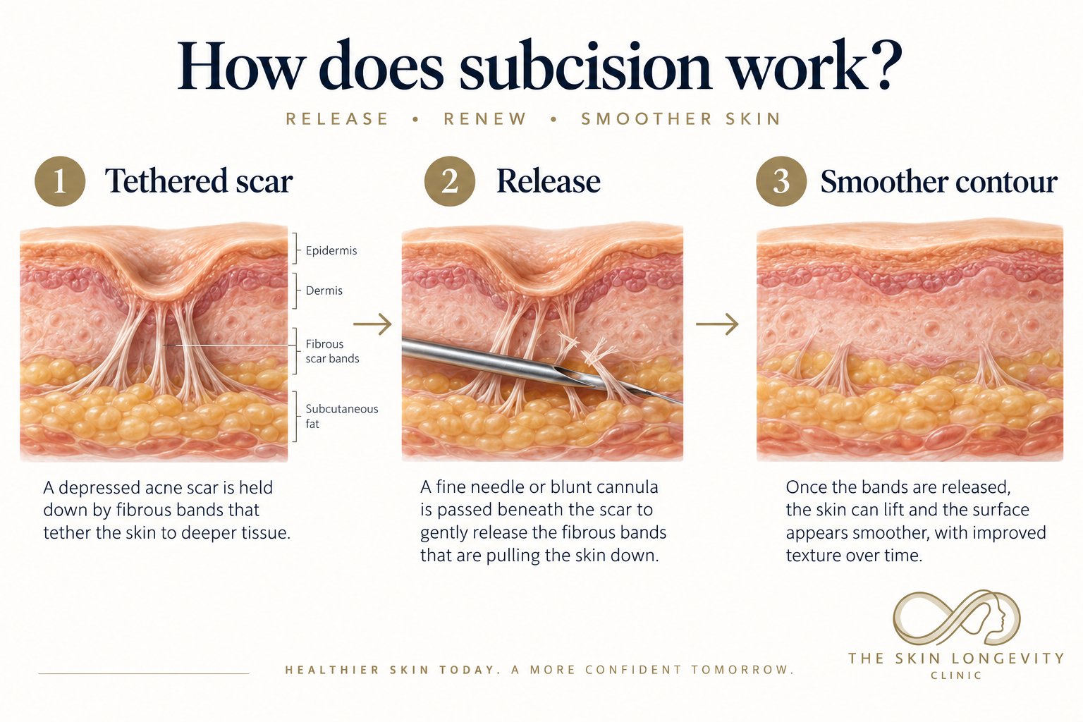 How subcision works in three steps: a tethered acne scar held by fibrous bands, release of the bands with a needle or blunt cannula, then a smoother skin contour