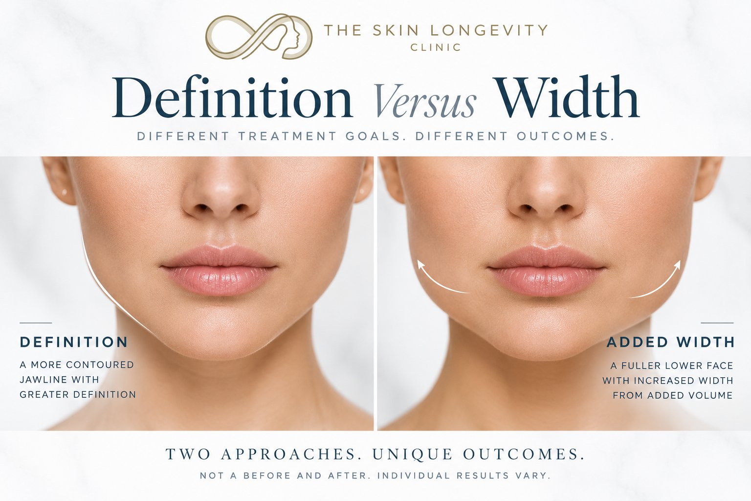 Jawline filler definition versus width: a more contoured jawline compared with added lower face width