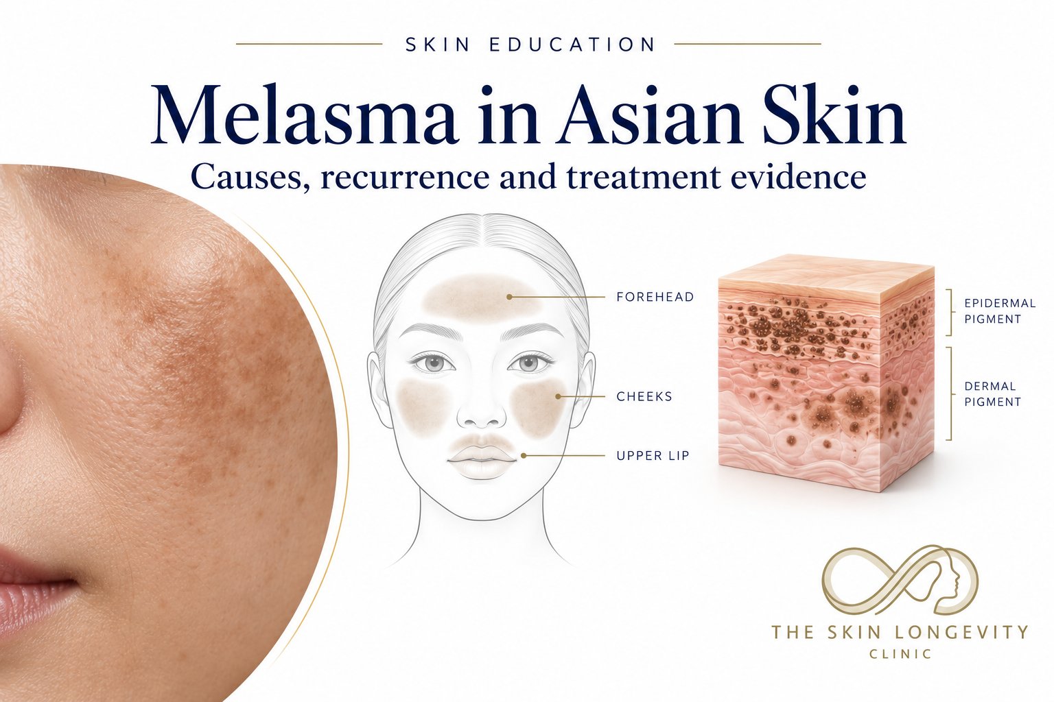 Melasma in Asian skin: typical forehead, cheek and upper lip pattern with epidermal and dermal pigment, from the melasma treatment Singapore guide