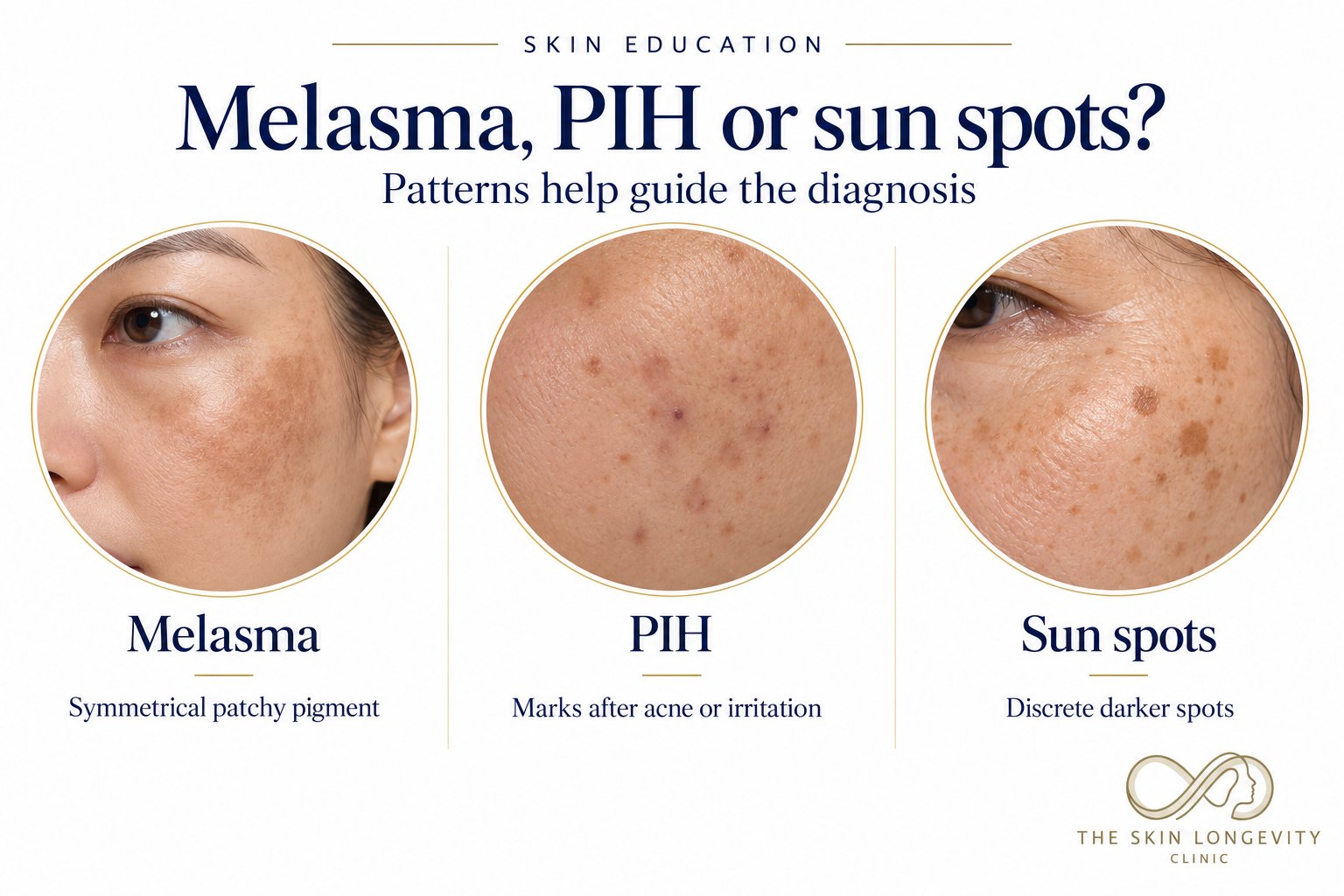 Melasma vs post-inflammatory hyperpigmentation (PIH) vs sun spots: symmetrical patches, marks after acne and discrete darker spots