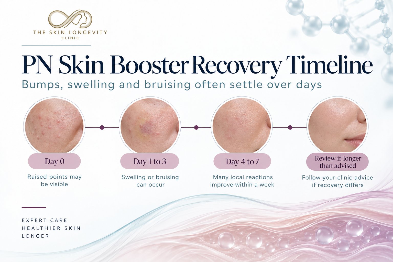 PN skin booster recovery timeline: raised points on day 0, swelling or bruising on days 1 to 3, many local reactions improving by days 4 to 7, and review if recovery takes longer than advised