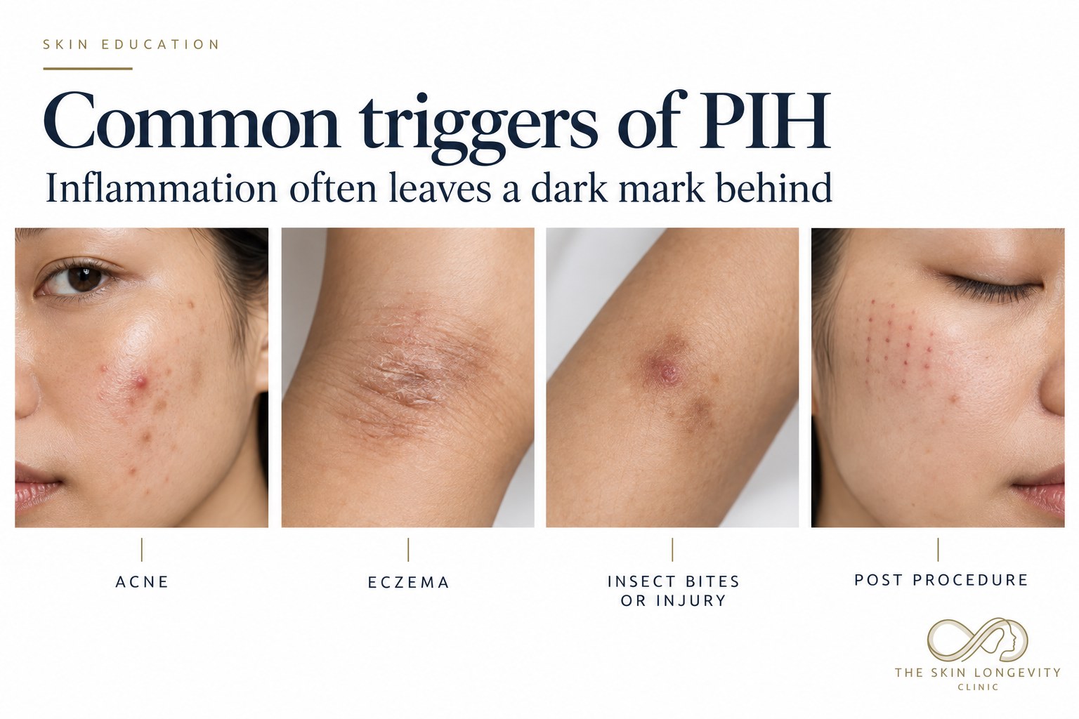 Common triggers of PIH: acne, eczema, insect bites or injury, and inflammation after a procedure