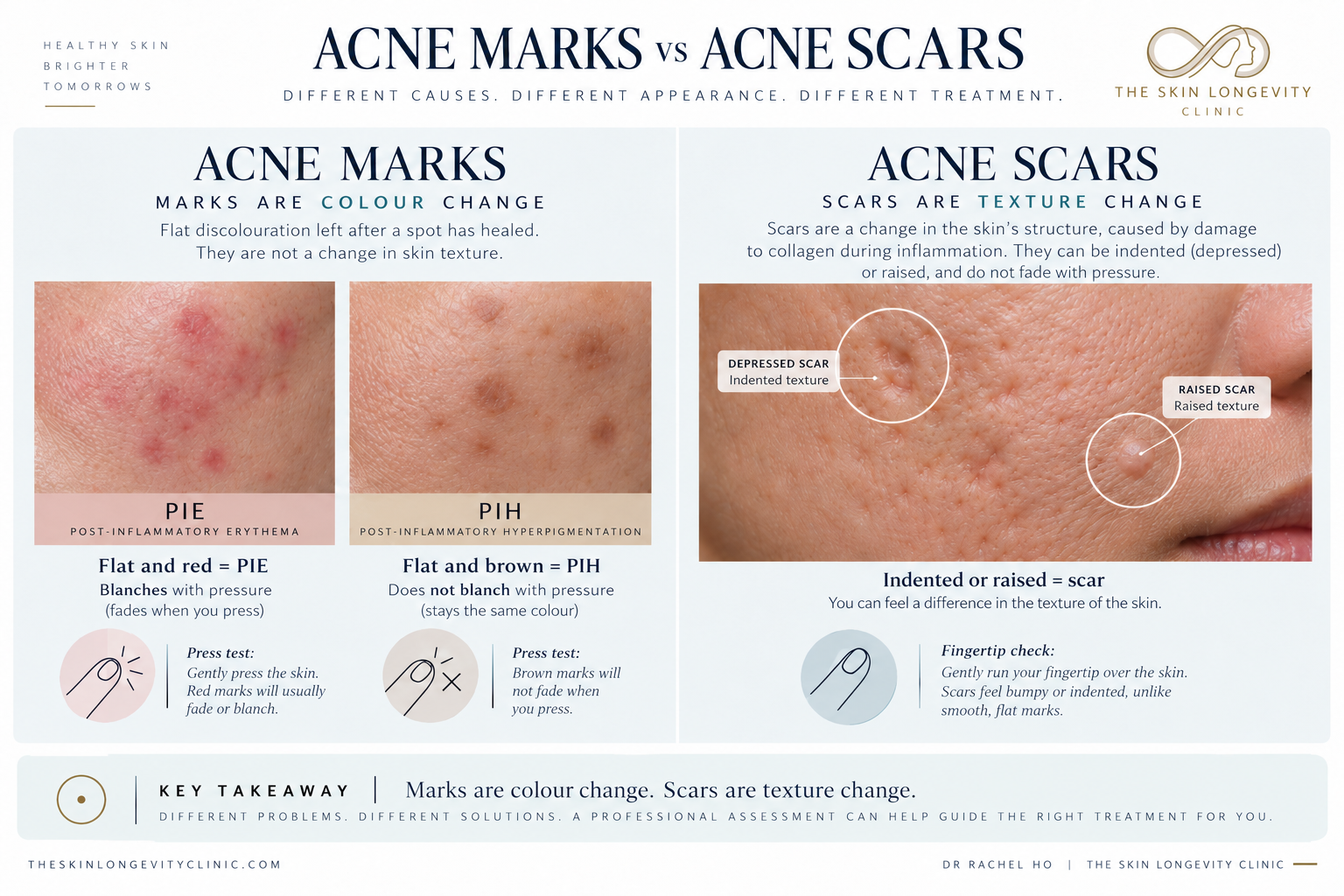 Comparison of flat red PIE and brown PIH acne marks with indented and raised scars, including pressure and texture checks