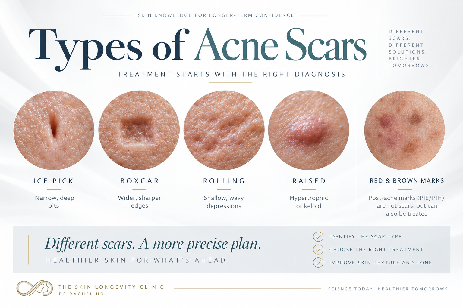 Illustrated comparison of ice pick, boxcar, rolling and raised acne scars, with flat red and brown acne marks shown separately.