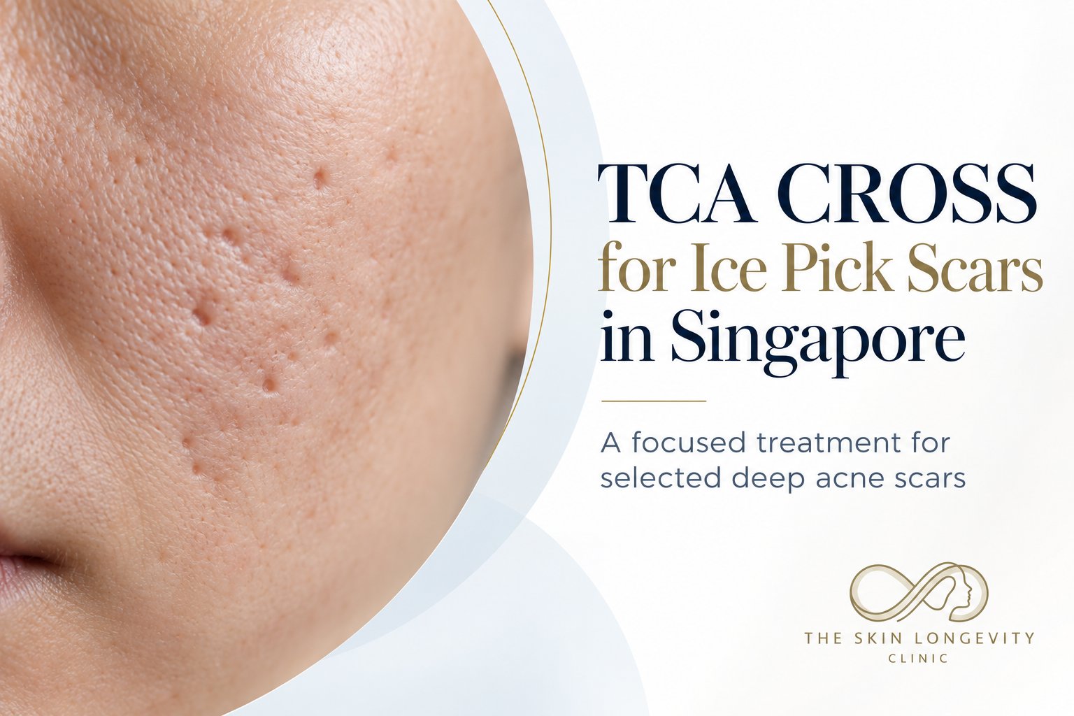 TCA CROSS for ice pick scars in Singapore: a focused treatment for selected deep acne scars, shown on a cheek with pitted ice pick scarring