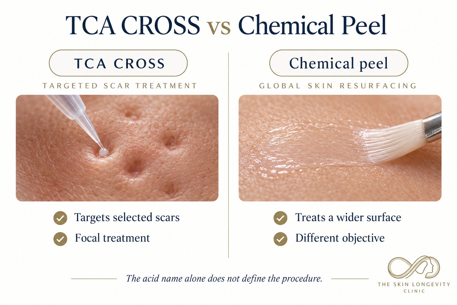 TCA CROSS versus chemical peel: TCA CROSS is a targeted focal scar treatment applied into individual scars, a chemical peel resurfaces a wider skin surface