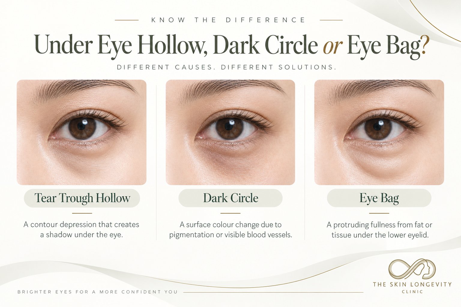 Under eye hollow vs dark circle vs eye bag: tear trough filler treats the hollow, not pigmentation or fat prolapse