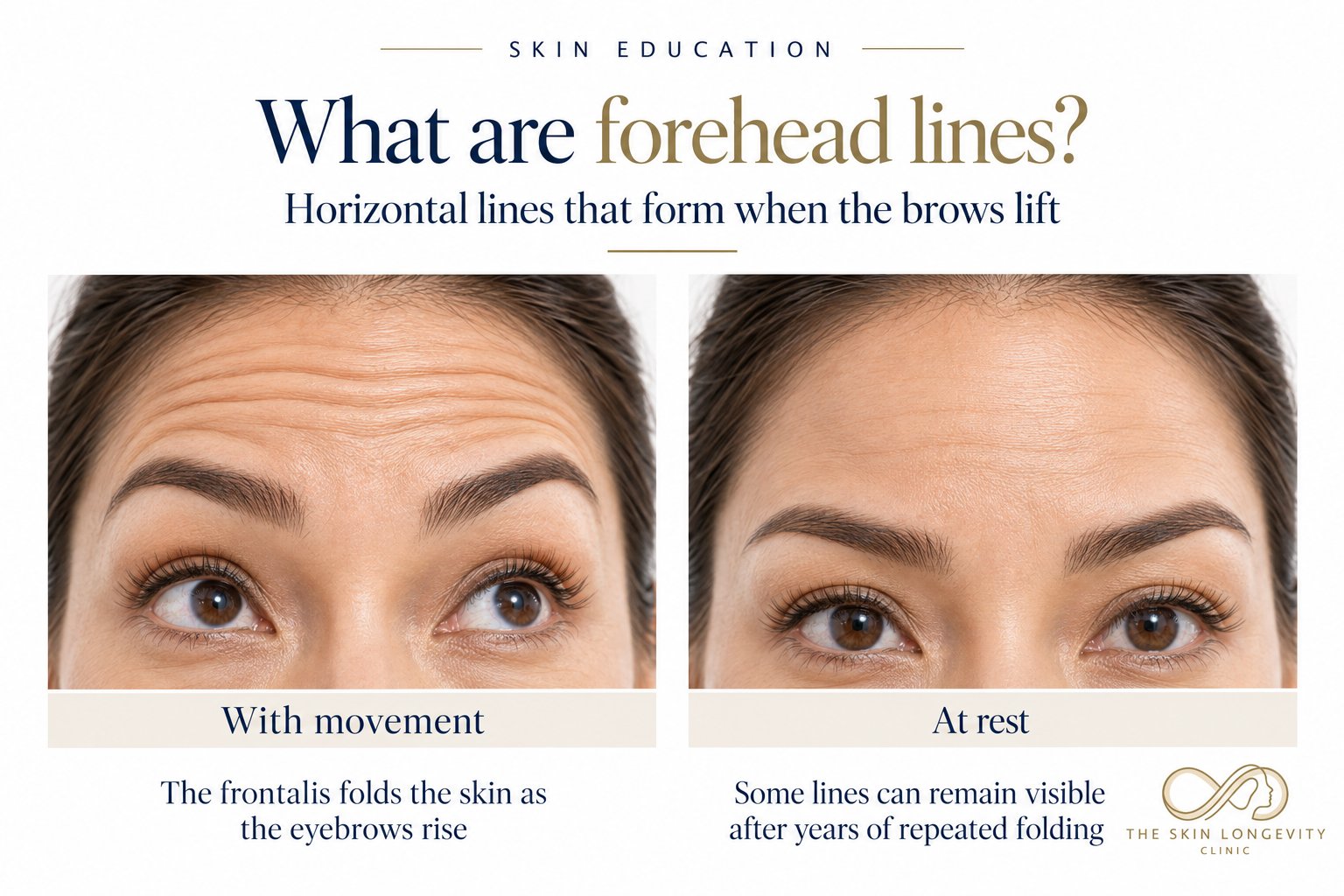 What are forehead lines: horizontal lines with frontalis movement and at rest