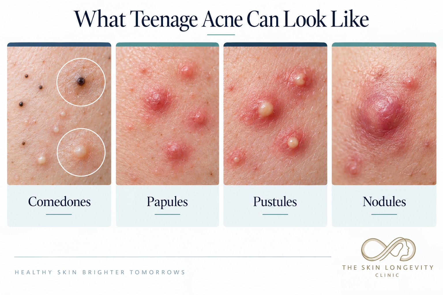What teenage acne can look like: comedones (blackheads and whiteheads), papules, pustules and nodules