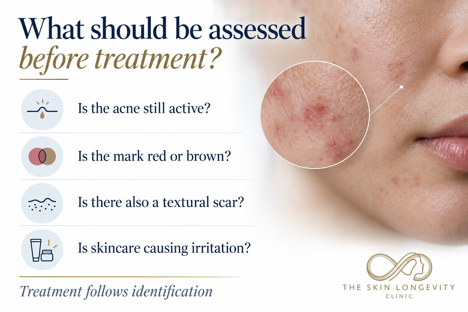 What should be assessed before treating red acne marks: whether acne is still active, whether the mark is red or brown, whether there is also a textural scar, and whether skincare is causing irritation