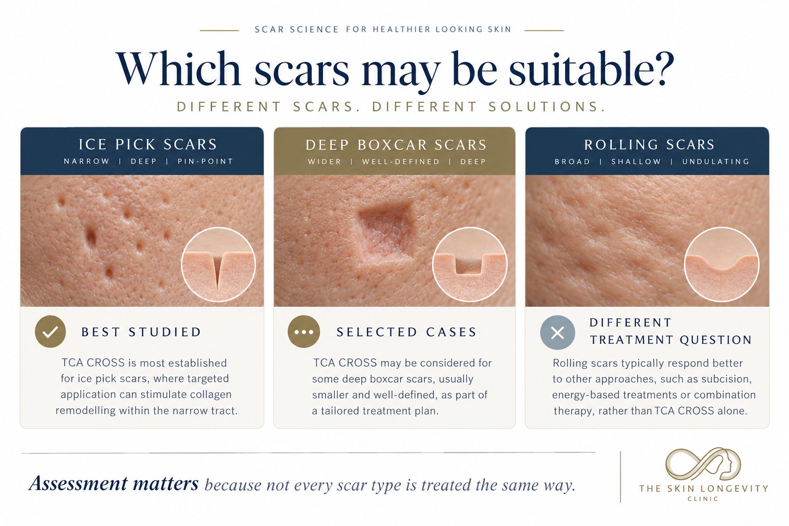 Which acne scars may be suitable for TCA CROSS: ice pick scars are best studied, deep boxcar scars in selected cases, rolling scars need a different approach such as subcision