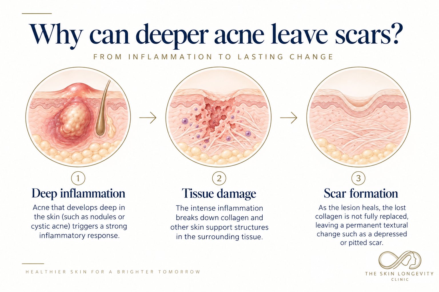 Why deeper cystic acne can leave scars: deep inflammation, tissue damage breaking down collagen, then scar formation with a depressed or pitted scar