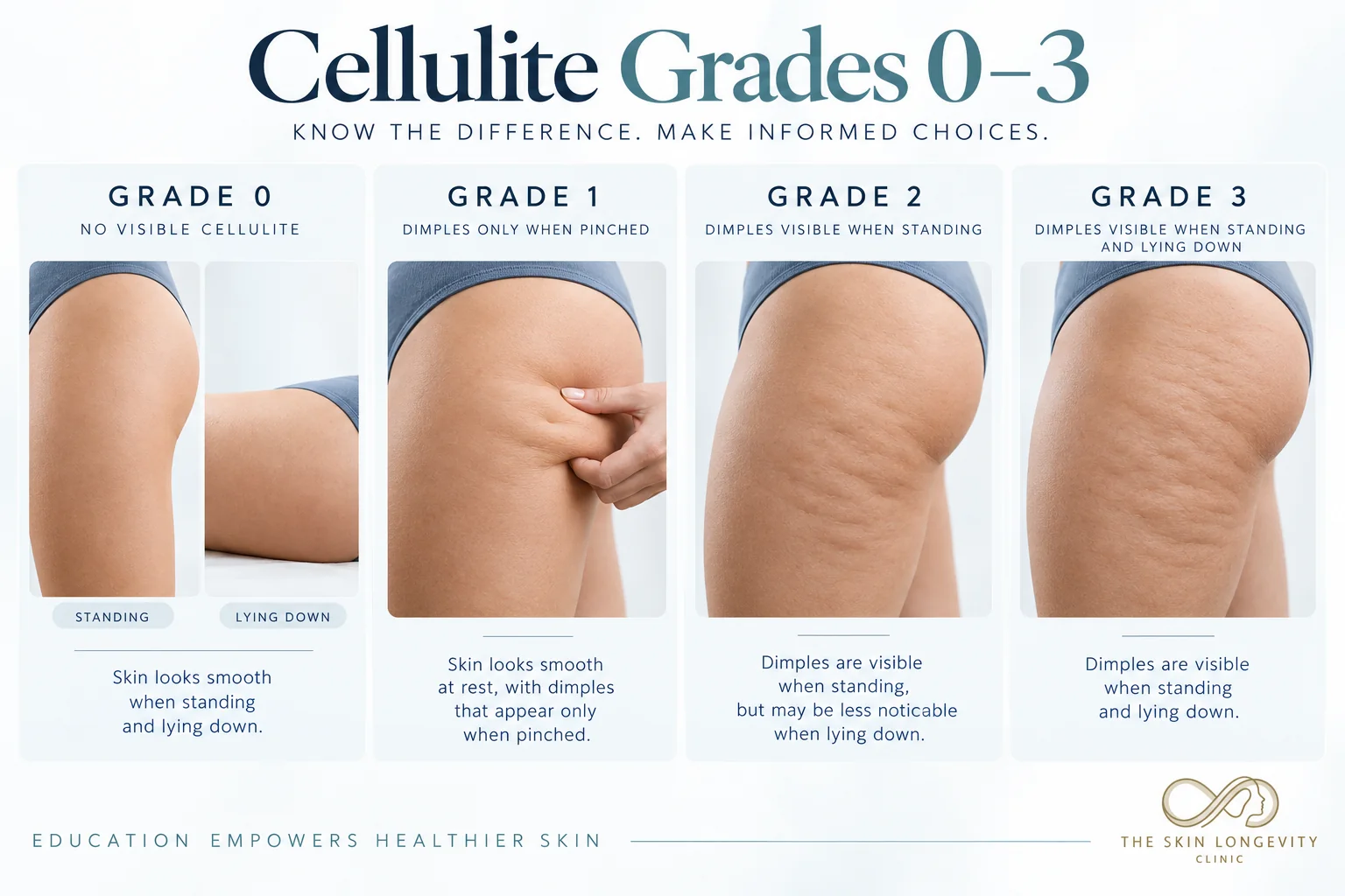 Cellulite grades 0 to 3 on the thighs: from smooth skin to dimples visible standing and lying down