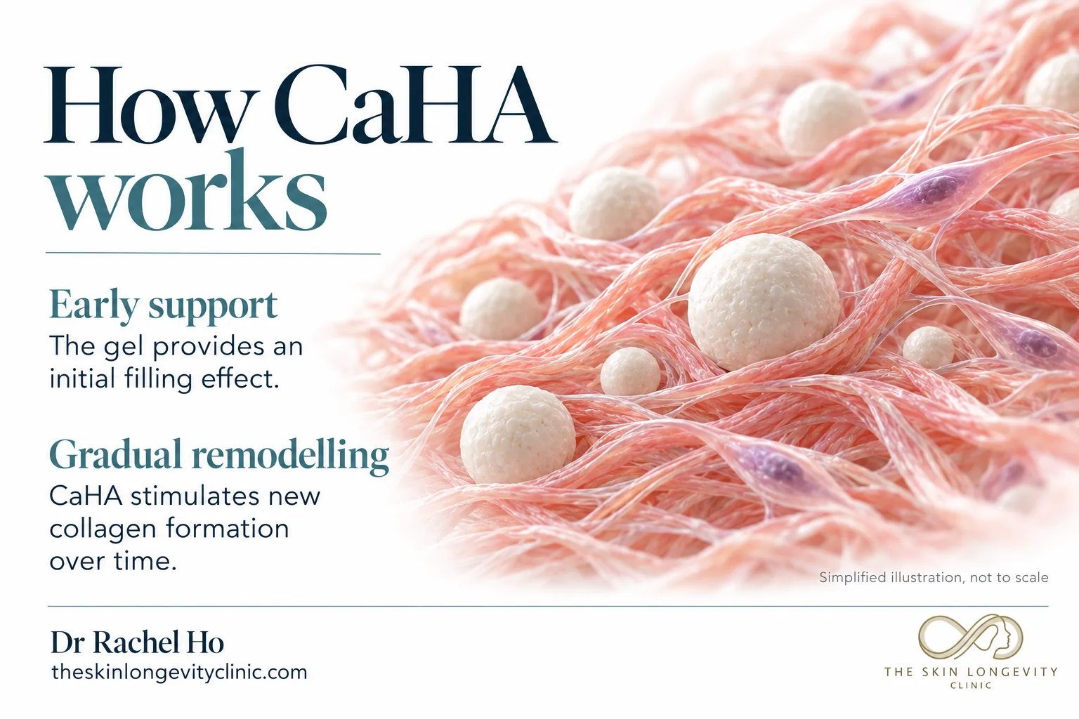 How CaHA collagen biostimulator works: the gel gives early support, then CaHA microspheres stimulate gradual collagen remodelling
