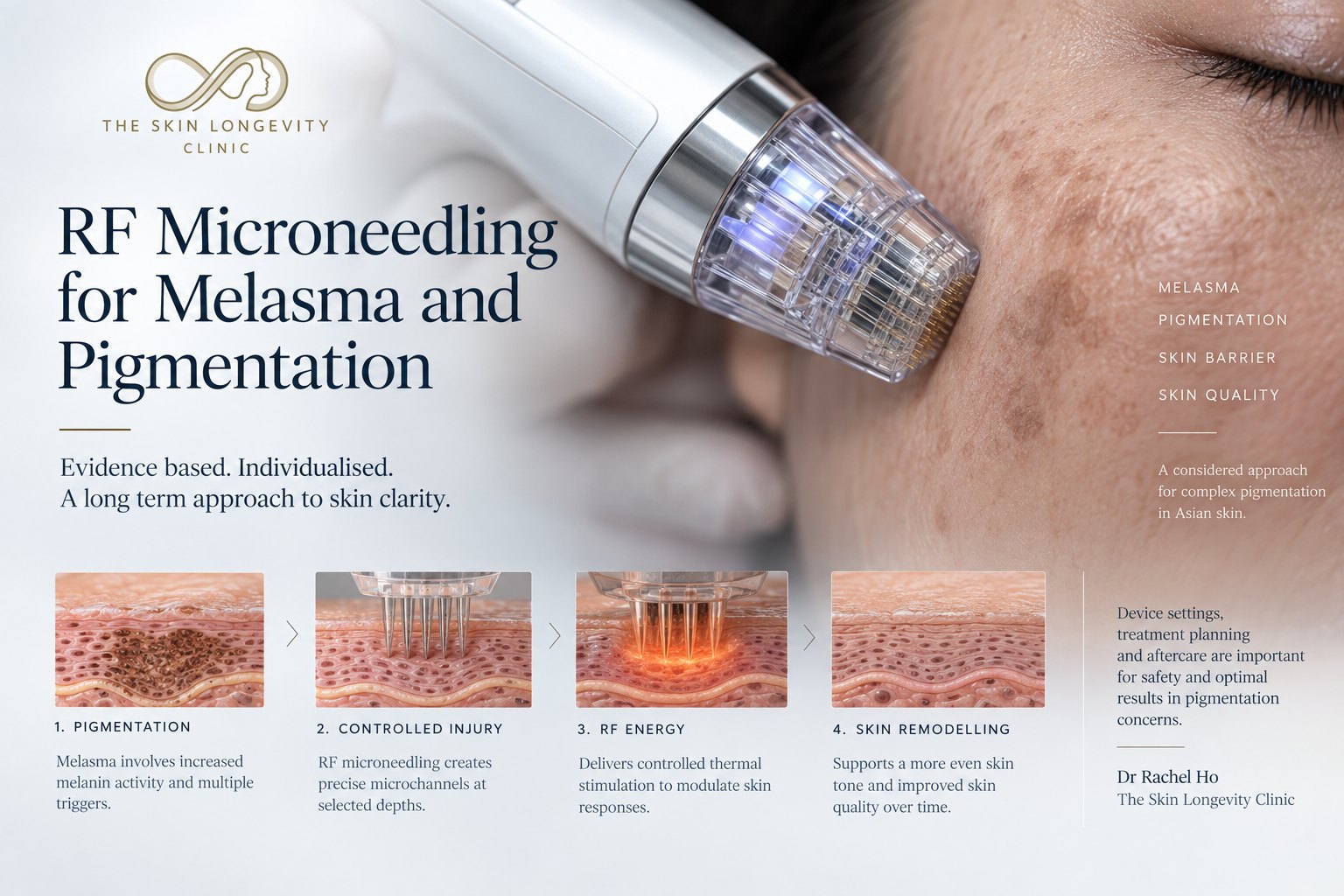 How RF microneedling works for melasma: pigmentation, controlled microchannels, RF energy and skin remodelling in four steps