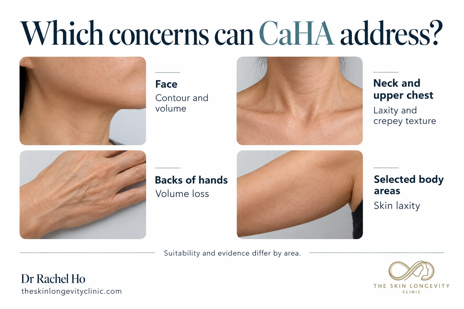 Which concerns CaHA (Radiesse) can address: face contour and volume, neck and upper chest laxity, backs of hands volume loss, body skin laxity