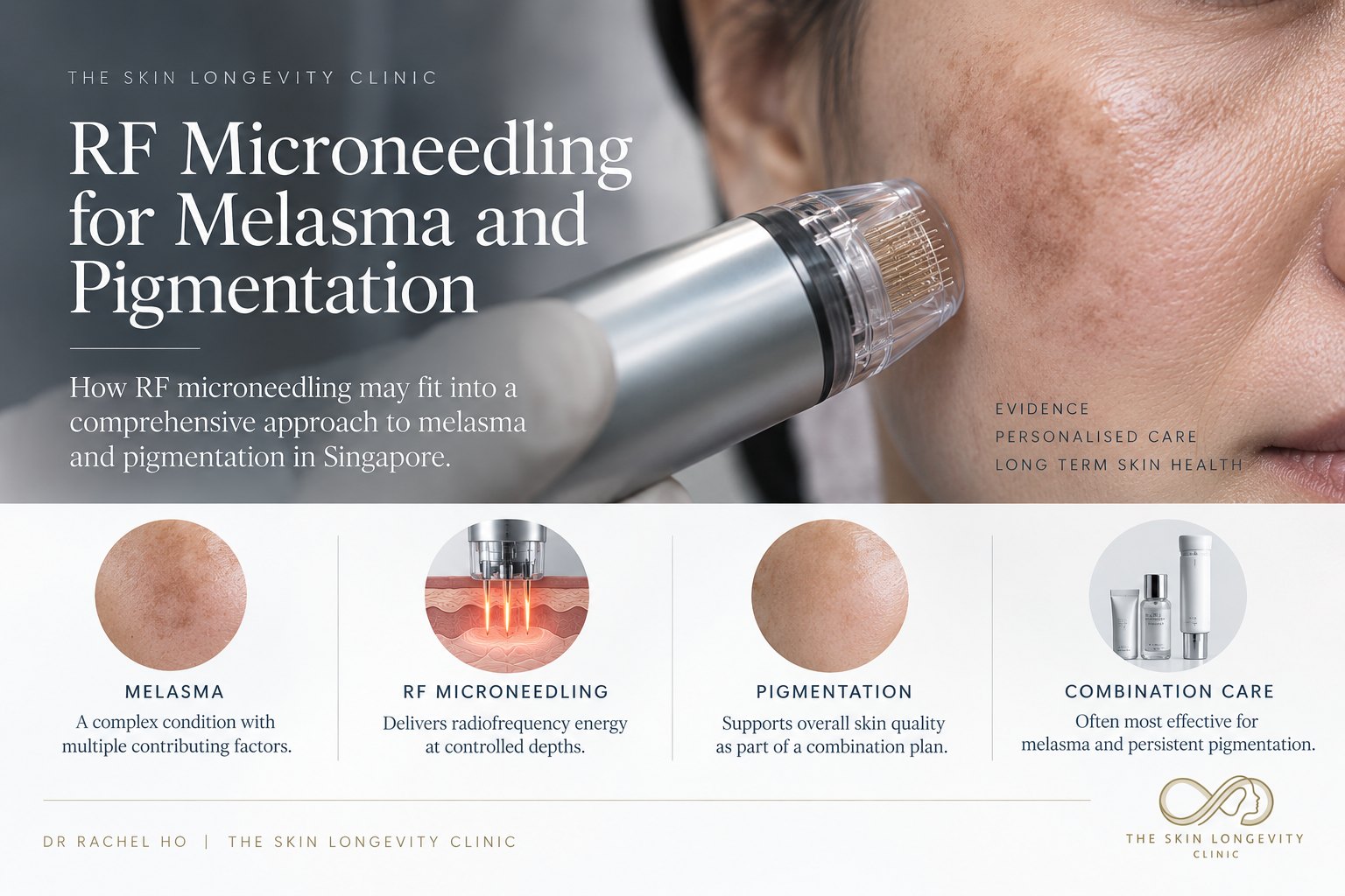 RF microneedling for melasma and pigmentation: melasma, RF microneedling, pigmentation and combination care with skincare