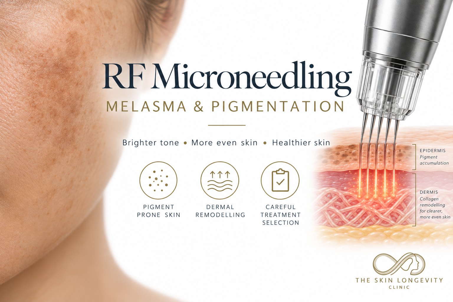 RF microneedling for melasma and pigmentation in Singapore: dermal remodelling beneath pigment-prone skin