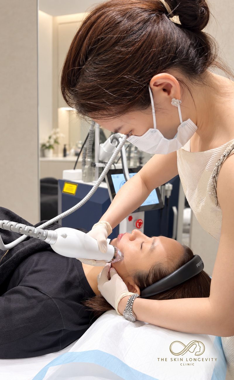 RF microneedling in Singapore along the jawline and lower face, performed by Dr Rachel Ho